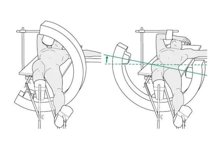 फेमोरल इंट्रामेडुलरी नेलिंग: प्रमुख सर्जिकल सिद्धांत 