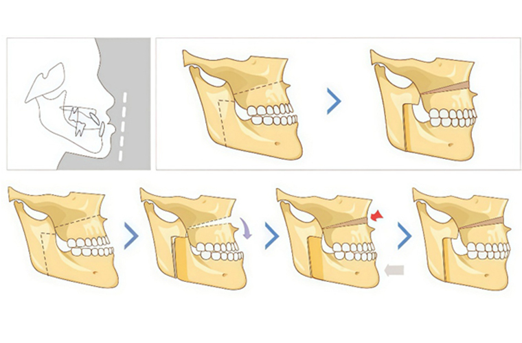 L’ère de la médecine de précision en chirurgie maxillo-faciale mini-invasive